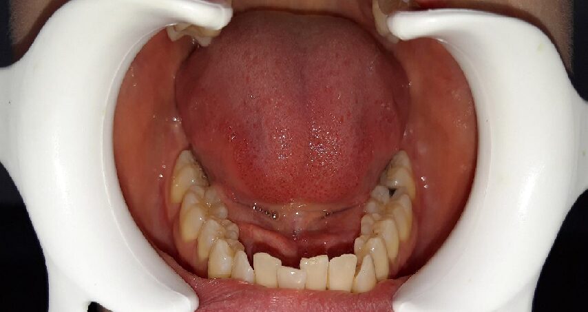 Avant traitement d'orthodontie – cas 1
