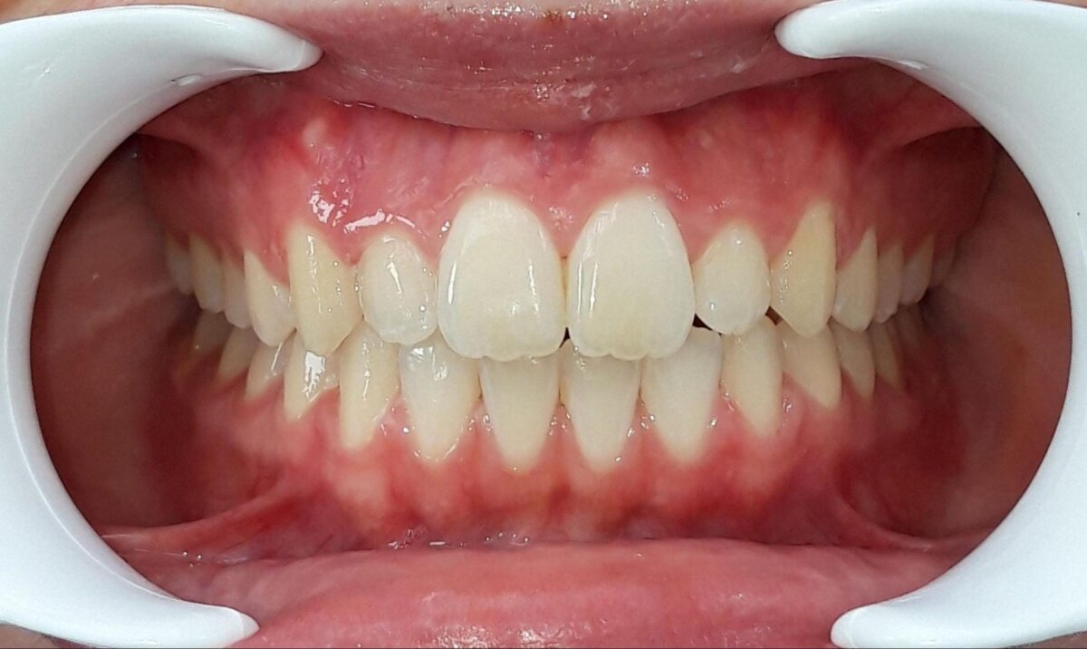 Après traitement d'orthodontie – cas 2