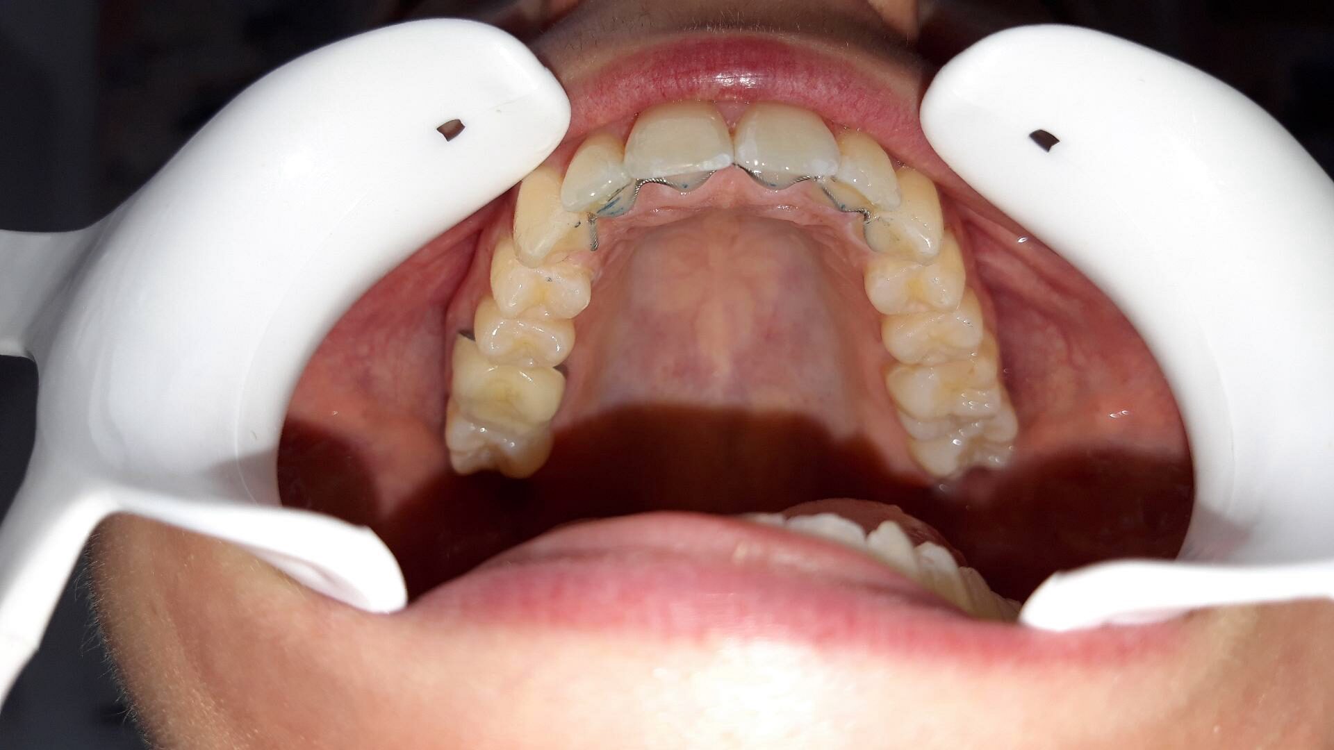 Après traitement d'orthodontie – cas 1