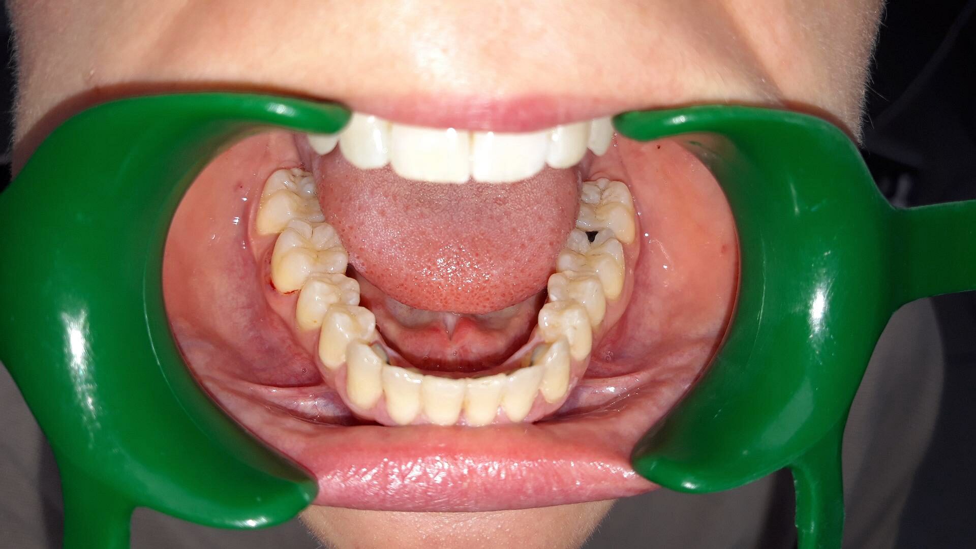 Après traitement d'orthodontie – cas 1