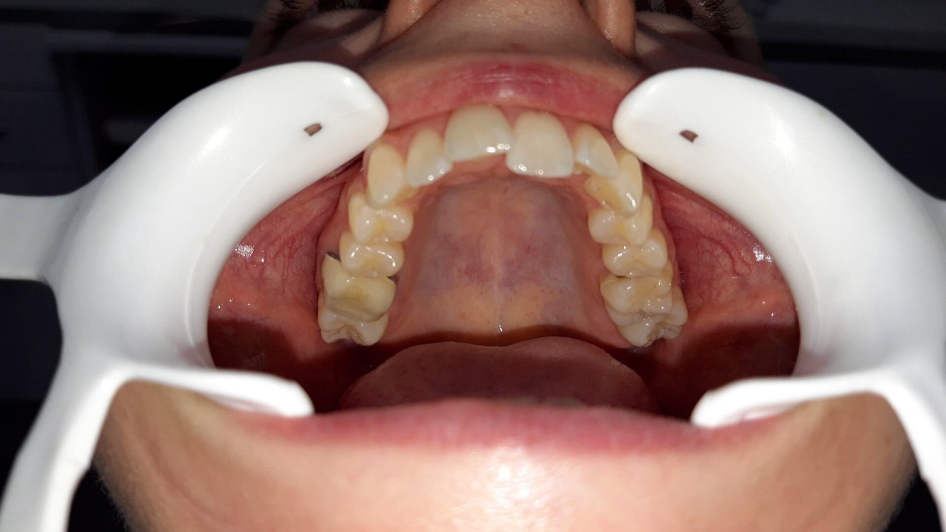 Avant traitement d'orthodontie – cas 1