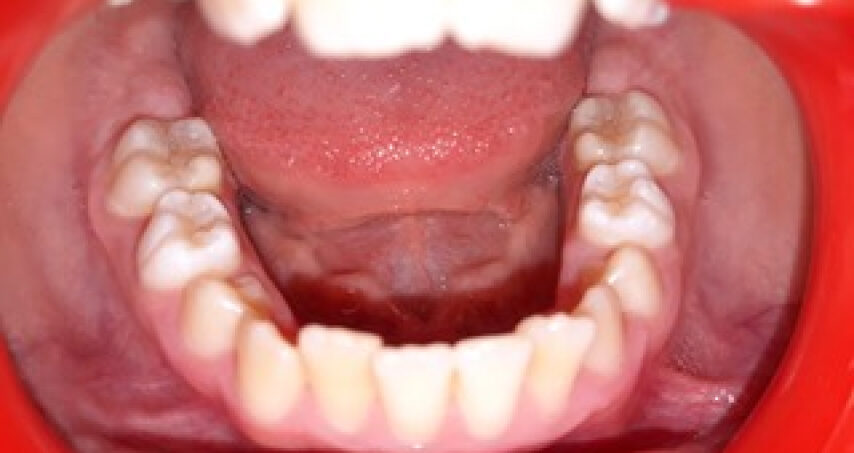 Avant traitement d'orthodontie – cas 4