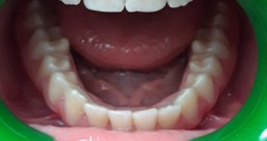 Après traitement d'orthodontie – cas 4