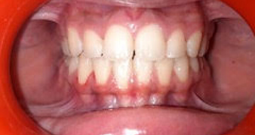 Avant traitement d'orthodontie – cas 6