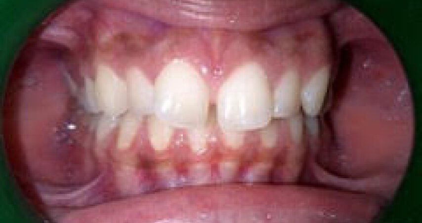 Après traitement d'orthodontie – cas 6