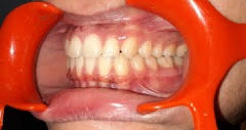 Avant traitement d'orthodontie – cas 6