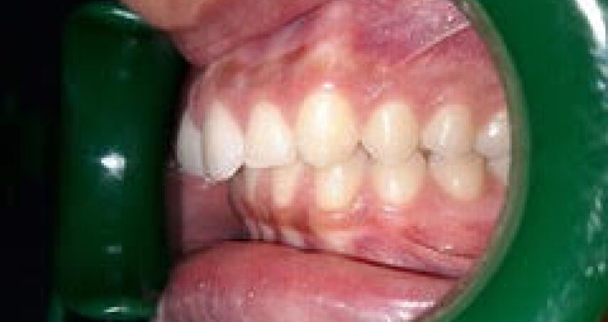 Après traitement d'orthodontie – cas 6