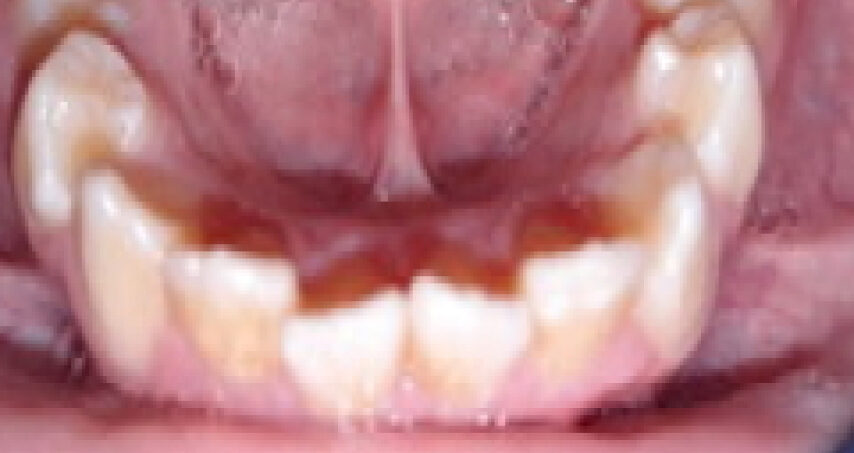 Avant traitement d'orthodontie – cas 3