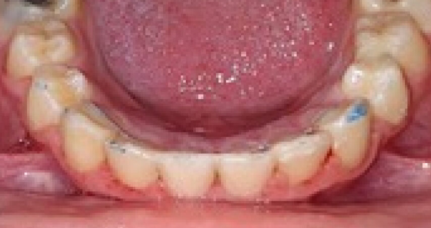 Après traitement d'orthodontie – cas 3