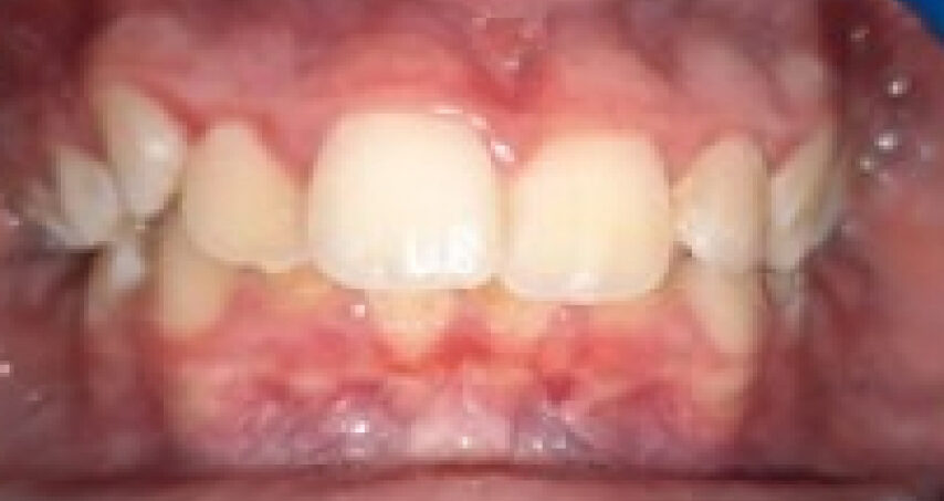 Avant traitement d'orthodontie – cas 3