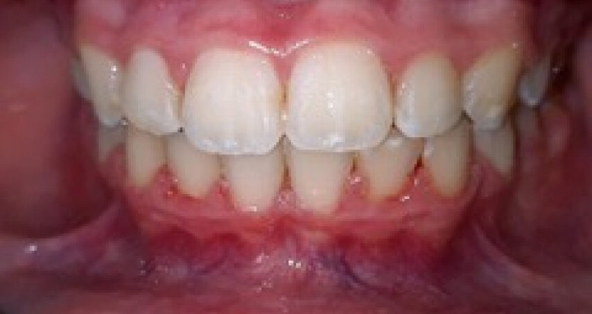 Après traitement d'orthodontie – cas 3
