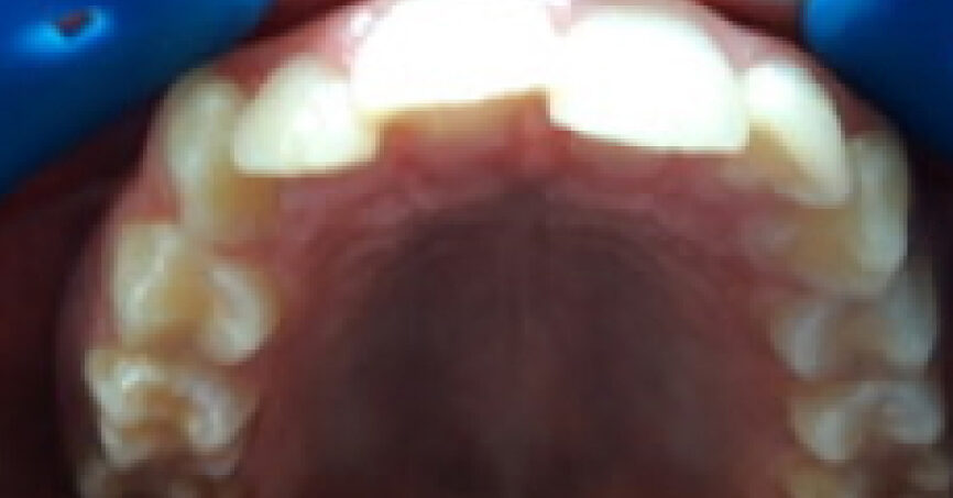 Avant traitement d'orthodontie – cas 3