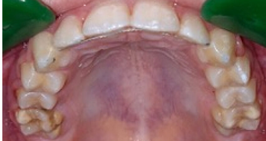 Après traitement d'orthodontie – cas 3