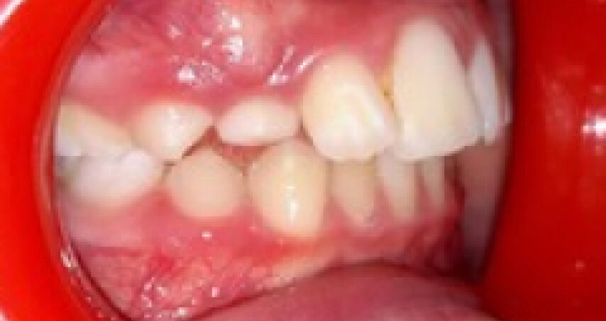 Avant traitement d'orthodontie – cas 4