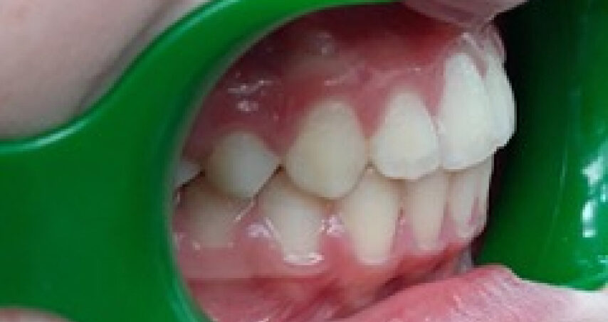 Après traitement d'orthodontie – cas 4
