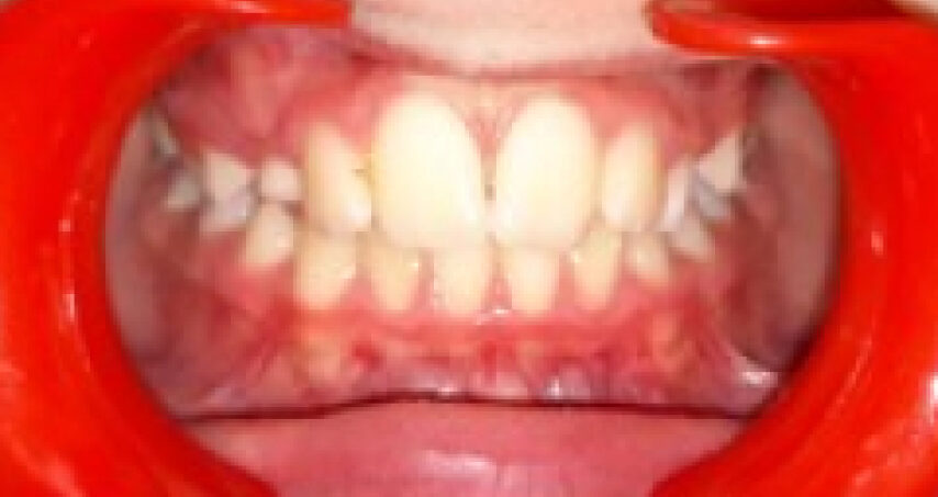 Avant traitement d'orthodontie – cas 4