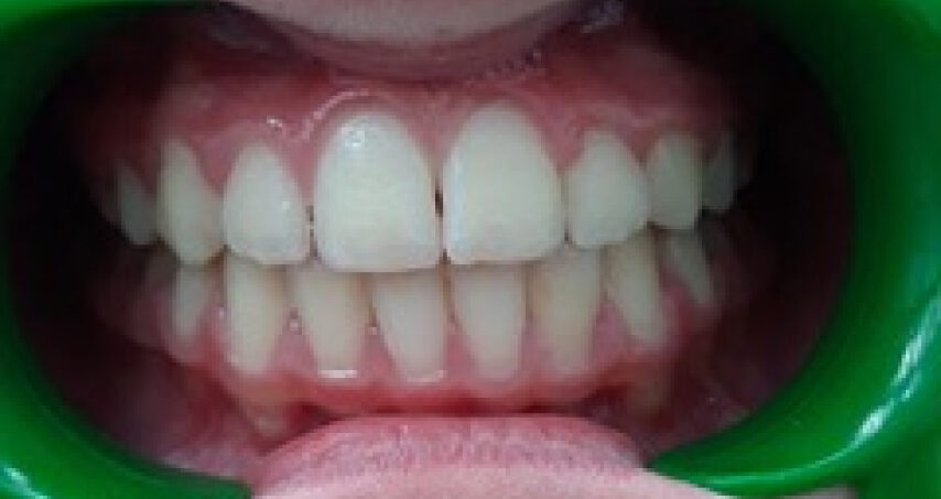 Après traitement d'orthodontie – cas 4