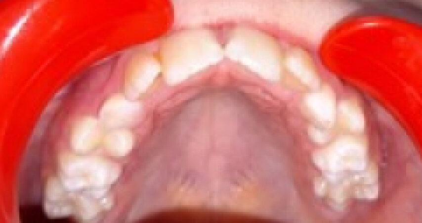 Avant traitement d'orthodontie – cas 4