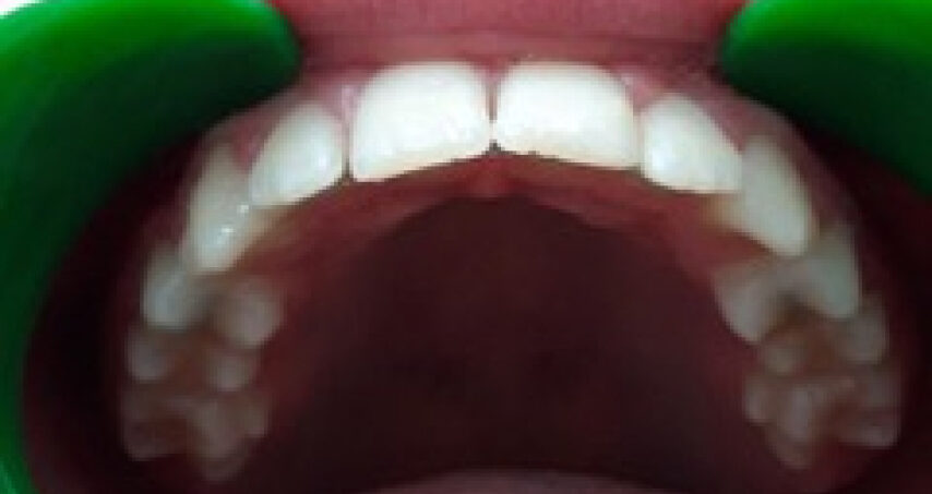 Après traitement d'orthodontie – cas 4