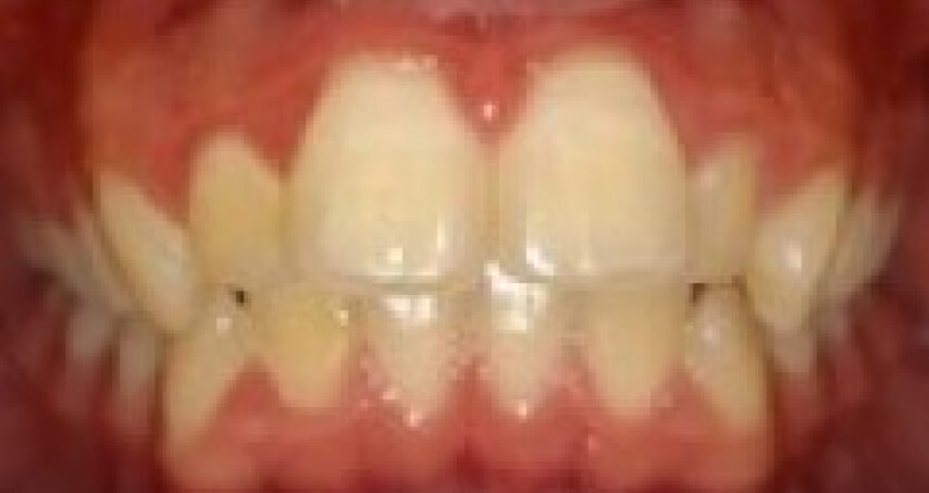 Avant traitement d'orthodontie – cas 5