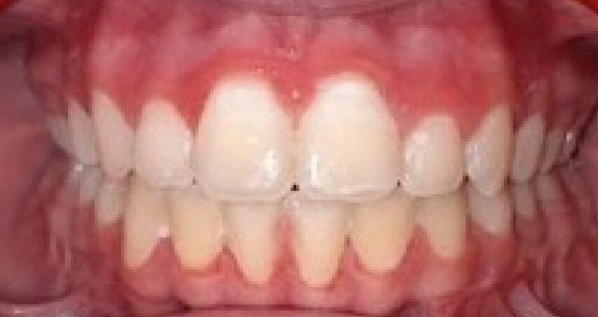 Après traitement d'orthodontie – cas 5