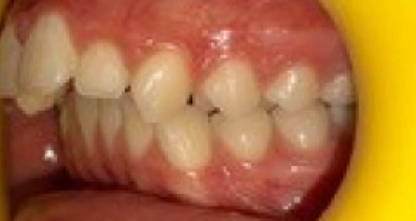 Avant traitement d'orthodontie – cas 5