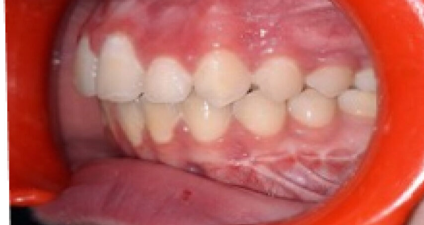 Après traitement d'orthodontie – cas 5