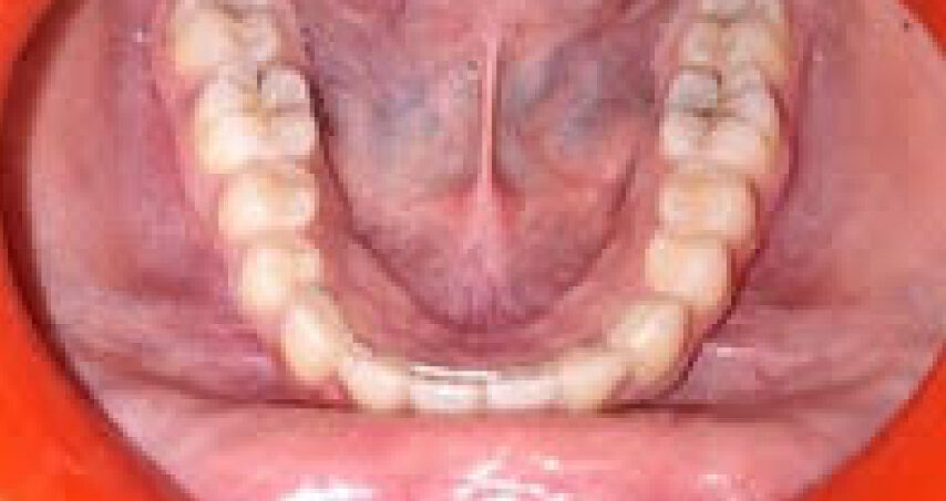 Avant traitement d'orthodontie – cas 6