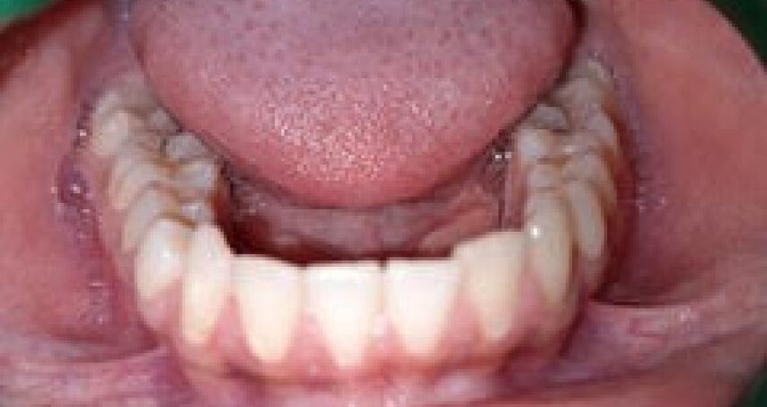 Après traitement d'orthodontie – cas 6