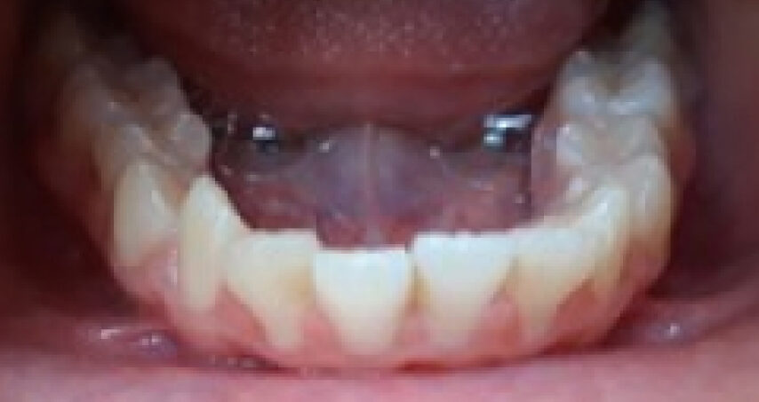 Avant traitement d'orthodontie – cas 7
