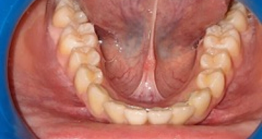 Après traitement d'orthodontie – cas 7
