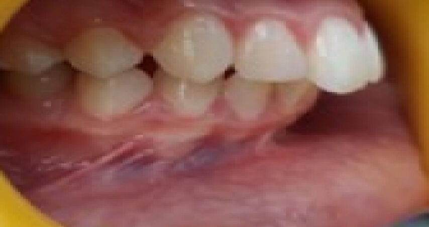 Avant traitement d'orthodontie – cas 7