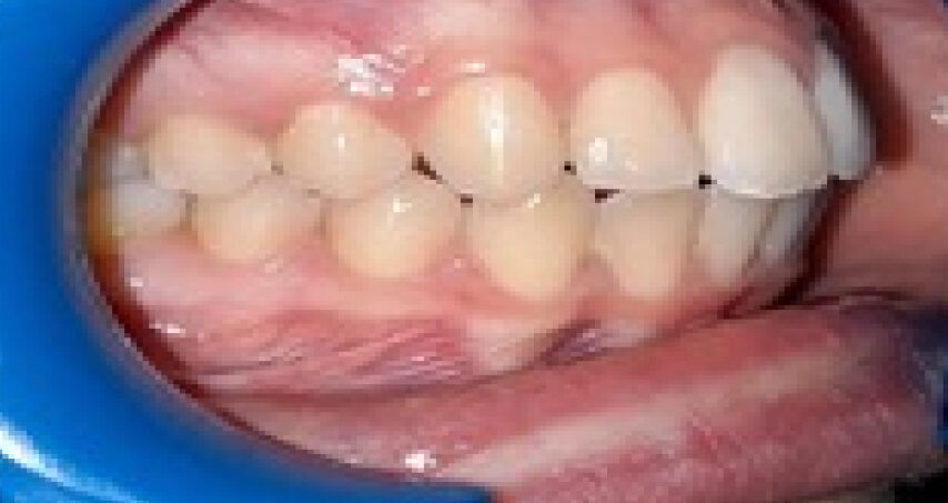 Après traitement d'orthodontie – cas 7