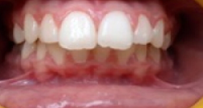 Avant traitement d'orthodontie – cas 7