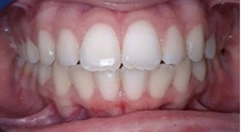 Après traitement d'orthodontie – cas 7