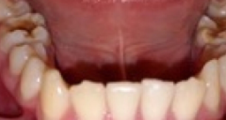 Avant traitement d'orthodontie – cas 8