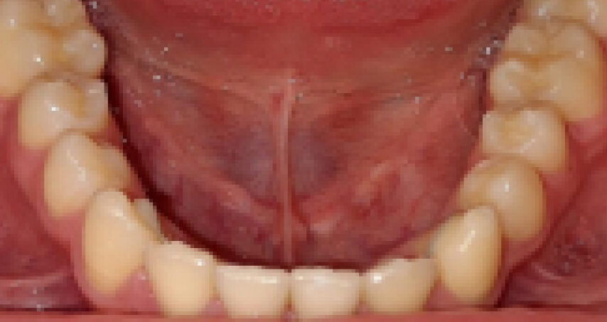 Après traitement d'orthodontie – cas 8