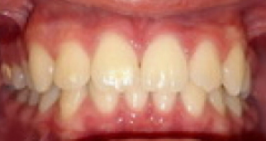 Avant traitement d'orthodontie – cas 8