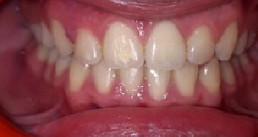 Après traitement d'orthodontie – cas 8