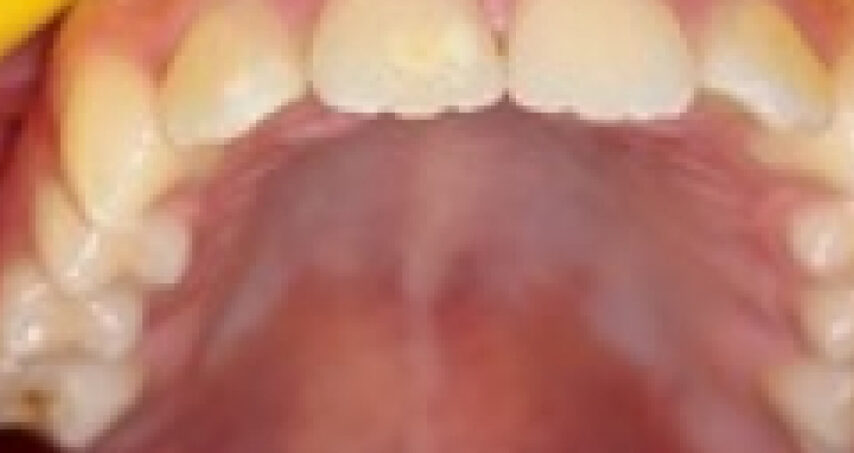 Avant traitement d'orthodontie – cas 8