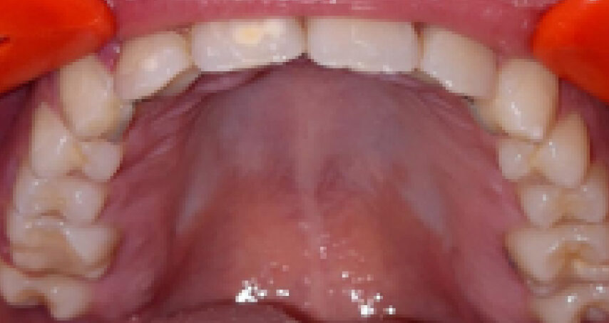 Après traitement d'orthodontie – cas 8