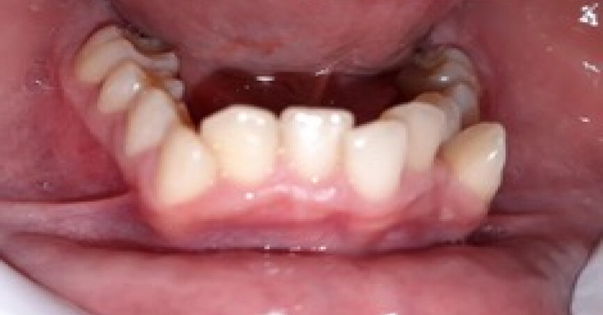 Avant traitement d'orthodontie – cas 9, vue du bas