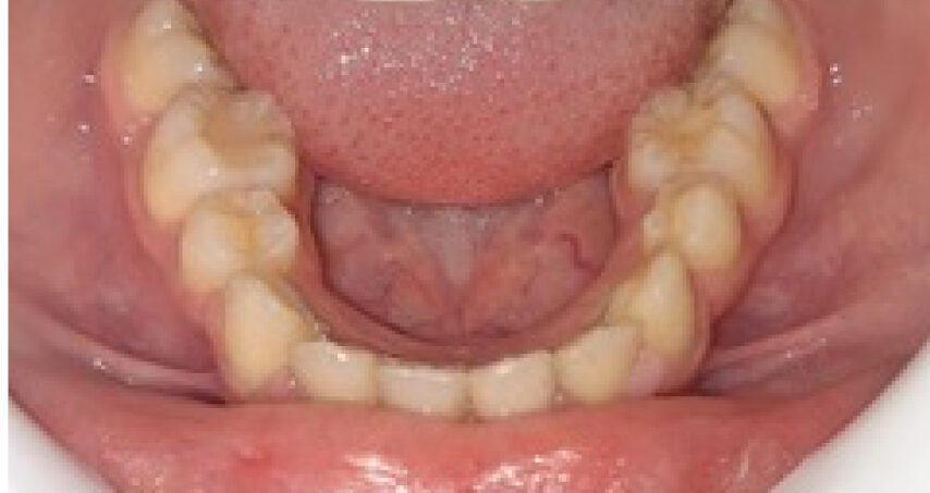 Après traitement d'orthodontie – cas 9, vue du bas