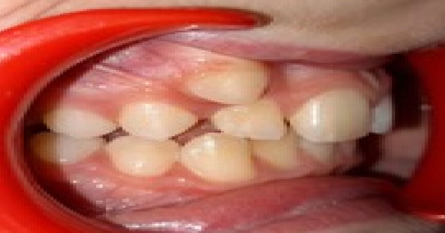 Avant traitement d'orthodontie – cas 10, vue de droite