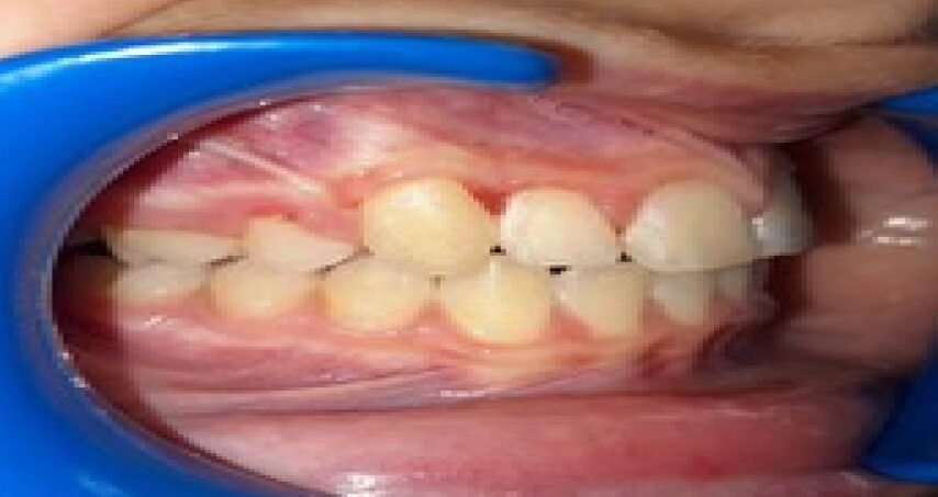Après traitement d'orthodontie – cas 10, vue de droite