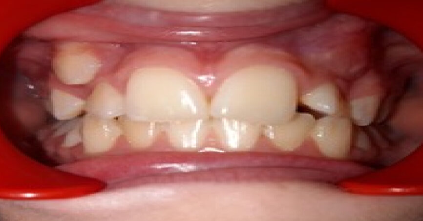 Avant traitement d'orthodontie – cas 10, vue de face