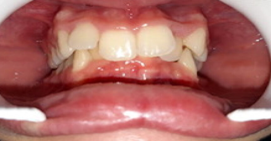 Avant traitement d'orthodontie – cas 9, vue de face