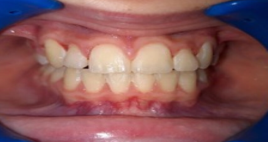 Après traitement d'orthodontie – cas 10, vue de face