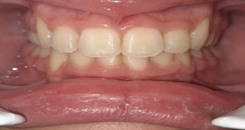 Après traitement d'orthodontie – cas 9, vue de face
