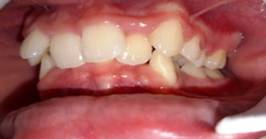 Avant traitement d'orthodontie – cas 9, vue de gauche